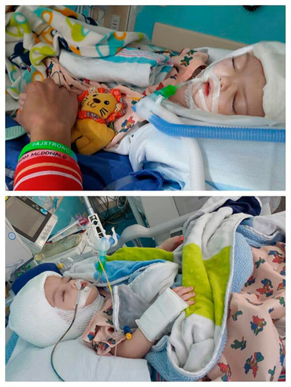 Conjoined Twins Successfully Separated At Montefiore|Conjoined Twins Successfully Separated At Montefiore