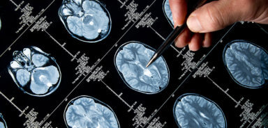 Pen pointing to MRI brain scan pictures