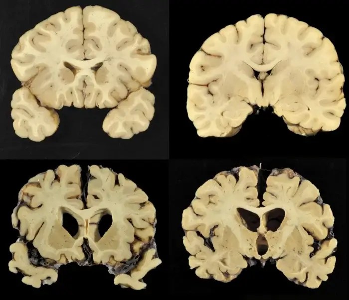 Brain scans for CTE.